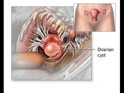 images chist ovarian